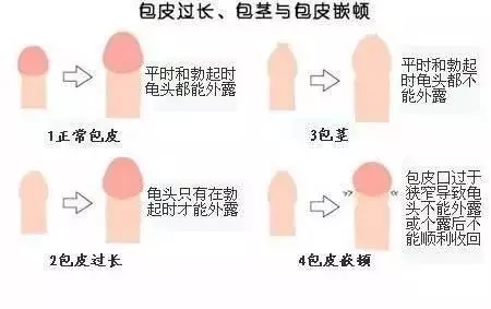 包皮包茎图片,包皮包茎区别,包皮包茎手术,包皮包茎危害,包皮包茎费用
