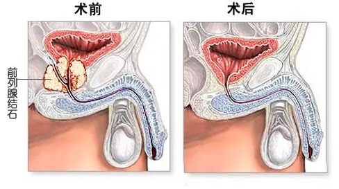 前列腺结石影响,前列腺结石症状,前列腺结石危害,治疗前列腺结石,前列腺结石病因