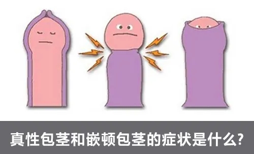 包皮包茎图片,包皮包茎费用,包皮包茎咨询,包皮包茎手术,包皮包茎区别