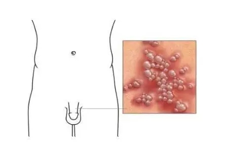 生殖器疱疹原因,生殖器疱疹治疗,生殖器疱疹症状,生殖器疱疹药物,生殖器疱疹危害