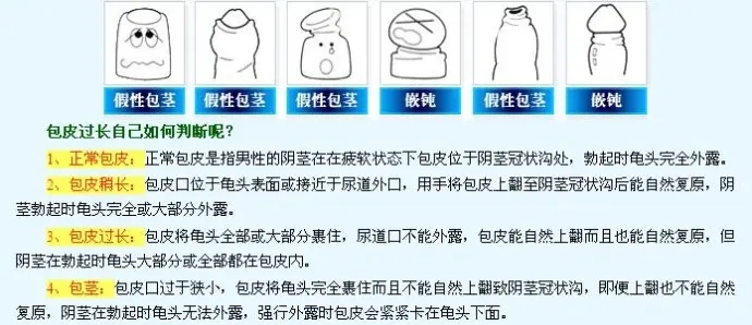 包皮包茎区别,包皮包茎症状,包皮包茎手术,包皮包茎危害