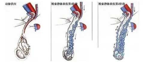精索静脉曲张病因,预防精索静脉曲张,治精索静脉曲张,精索静脉曲张危害,精索静脉曲张影响