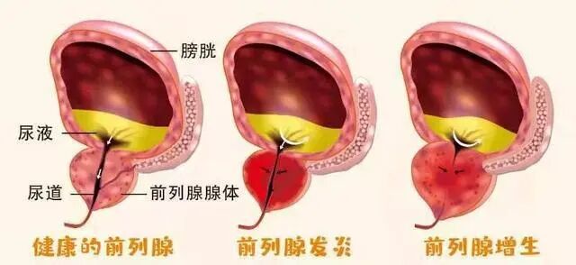 前列腺结石症状,前列腺结石原因,前列腺结石治疗,前列腺结石图片