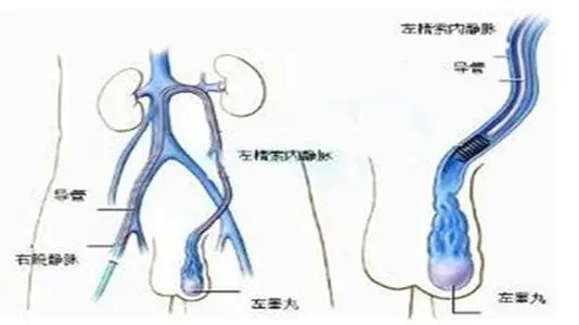 预防精索静脉曲张,精索静脉曲张病因,精索静脉曲张危害,治精索静脉曲张,精索静脉曲张影响