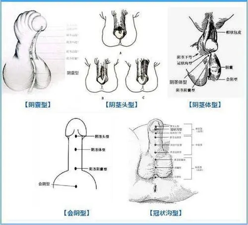 尿道畸形症状,尿道畸形原因,尿道畸形治疗,尿道畸形诊断