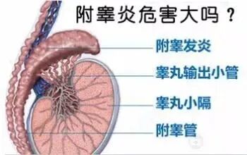 附睾炎治疗,附睾炎用药,附睾炎原因,附睾炎图片,附睾炎症状