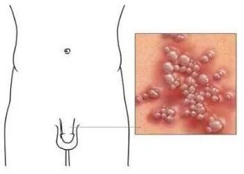 生殖器疱疹症状,生殖器疱疹病因,生殖器疱疹表现,生殖器疱疹预防,生殖器疱疹危害,生殖器疱疹检查