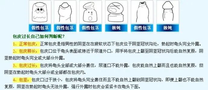包皮包茎手术,包皮包茎危害,包皮包茎图片,包皮包茎区别,包皮包茎费用