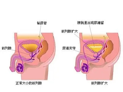 前列腺炎药物,前列腺炎治疗,前列腺炎用药,前列腺炎症状