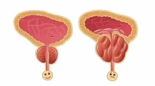 前列腺增生治疗,前列腺增生药物,前列腺增生症状,前列腺增生原因