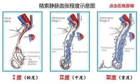 西安男科医院,精索静脉曲张危害,治精索静脉曲张,精索静脉曲张影响,精索静脉曲张病因,预防精索静脉曲张