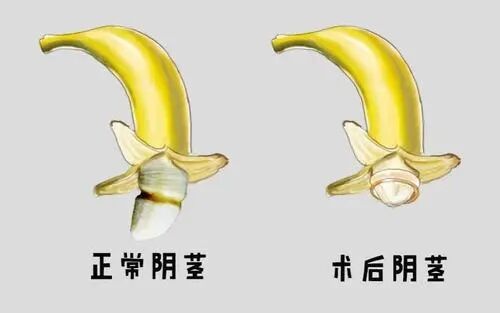 包皮过长危害,包皮过长图片,包皮过长早泄,包皮过长原因