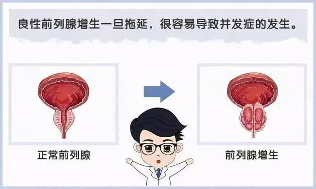 前列腺增生药物,前列腺增生原因,前列腺增生症状,前列腺增生治疗