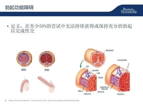 勃起障碍原因,勃起障碍症状,勃起障碍治疗,勃起障碍费用