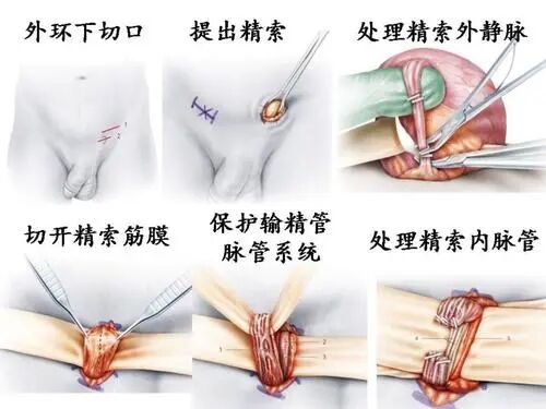 西安男科医院,精索静脉曲张危害,治精索静脉曲张,精索静脉曲张影响,精索静脉曲张病因,预防精索静脉曲张