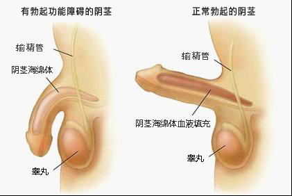 勃起障碍原因,勃起障碍症状,勃起障碍治疗,勃起障碍费用