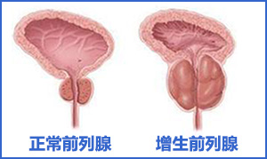 前列腺增生药物,前列腺增生原因,前列腺增生症状,前列腺增生治疗