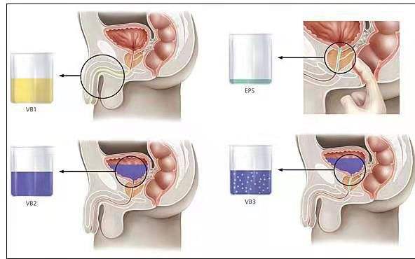 前列腺结石症状,前列腺结石原因,前列腺结石治疗,前列腺结石图片
