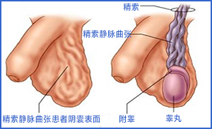 精索静脉曲张病因,预防精索静脉曲张,治精索静脉曲张,精索静脉曲张危害,精索静脉曲张影响