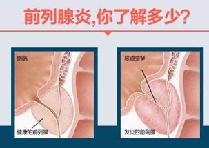 前列腺炎症状,前列腺炎表现,前列腺炎病因,前列腺炎预防,前列腺炎检查,前列腺炎危害