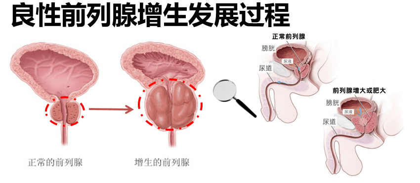 前列腺增生症状,前列腺增生表现,前列腺增生病因,前列腺增生预防,前列腺增生检查,前列腺增生危害