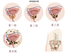 前列腺增生表现,前列腺增生症状,前列腺增生病因,前列腺增生预防,前列腺增生检查,前列腺增生危害