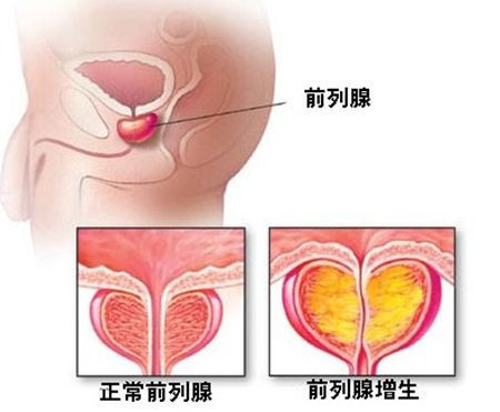 前列腺增生症状,前列腺增生表现,前列腺增生病因,前列腺增生预防,前列腺增生检查,前列腺增生危害