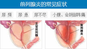 前列腺炎症状,前列腺炎表现,前列腺炎病因,前列腺炎预防,前列腺炎检查,前列腺炎危害